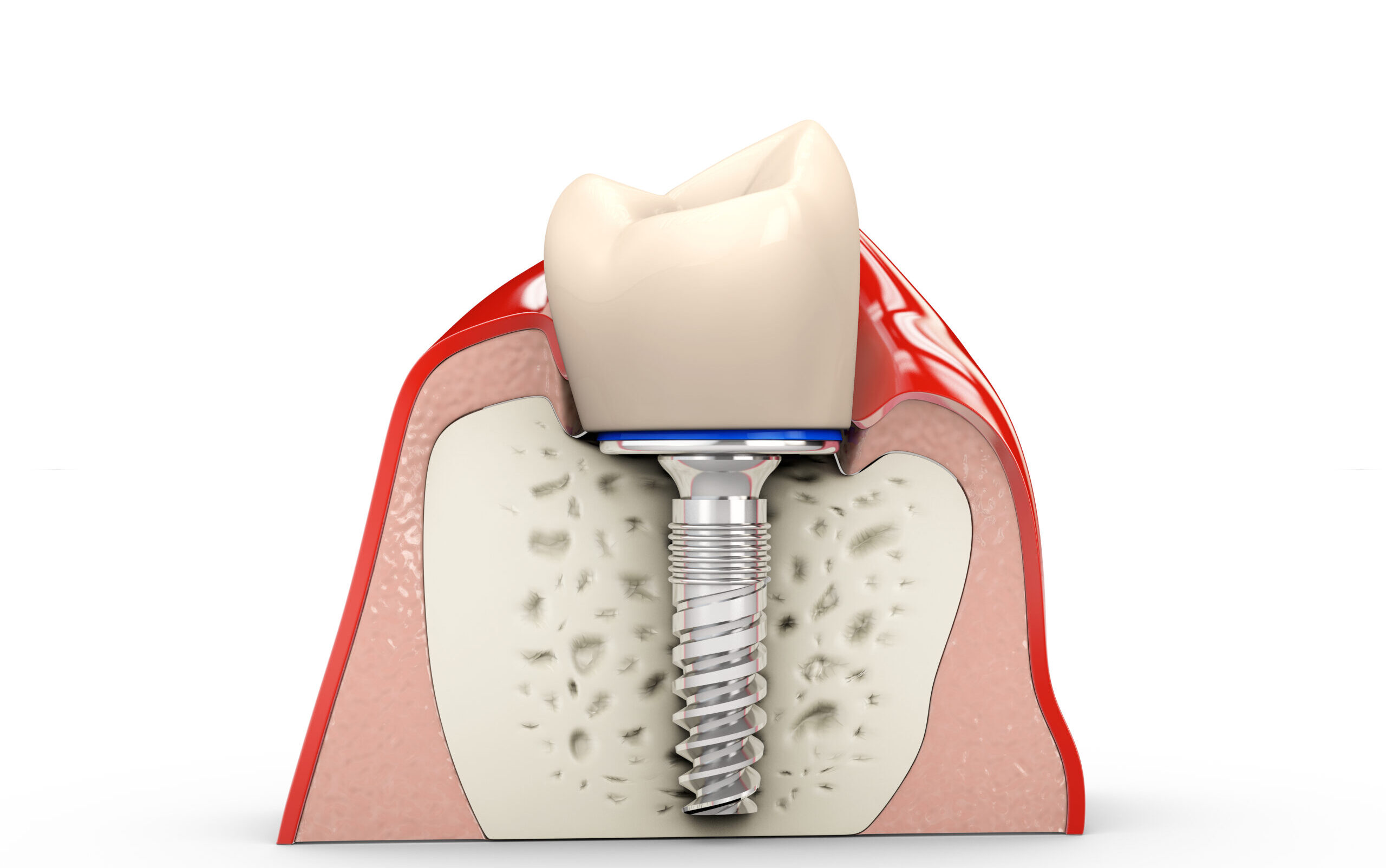 Single Tooth Implant